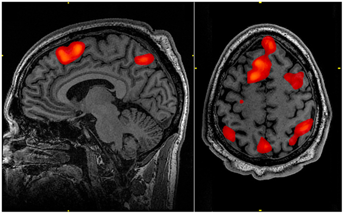 fmri-1